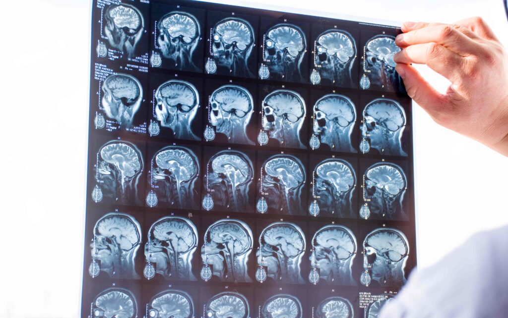 Traumatic Brain Injury scan